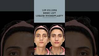 Transform Your Look Nose Lift amp Lip Fillers  Sarayu Clinics beauty [upl. by Girish]