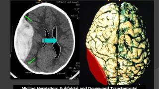 MedPix® Traumatic Brain Injury  Epidural Hematoma RadiologicPathologic Correlation [upl. by Hgielanna]