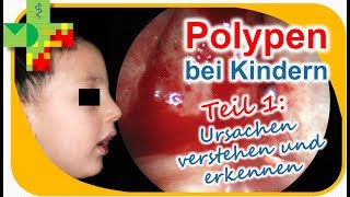 POLYPEN bei Kindern  Teil 1 [upl. by Hild]