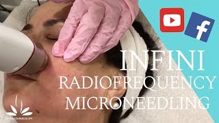 INFINI Radiofrequency Microneedling for Skin Rejuvenation [upl. by Orimisac]