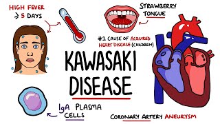 Kawasaki Disease Explained Includes Criteria amp Mnemonic [upl. by Orran325]