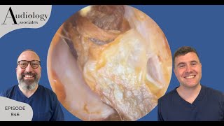 ITCHY EAR CANALS FIXED amp ANTERIOR RECESS EAR WAX REMOVAL  EP846 [upl. by Suoirrad]