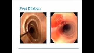 Eosinophilic Esophagitis [upl. by Yerffeg]