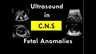 Ultrasound in CNS foetal anomalies [upl. by Yenaffit]