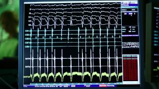 Ablacja arytmii komorowej u chorych bez organicznej choroby serca [upl. by Sabino]