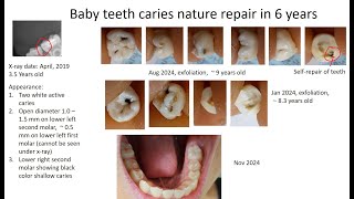 Baby teeth caries nature repair in 6 years [upl. by Ferneau]