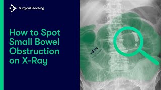 Small Bowel Obstruction  How do we Diagnose it on Abdominal XRay [upl. by Nrehtac]