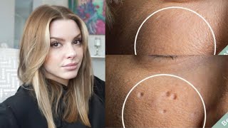 Esthetician Discusses How To Eliminate Pitted Acne Scars [upl. by Aihk]