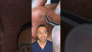 OMG I was not expecting that blackhead extraction on the nose Dr Somji reacts [upl. by Harahs767]