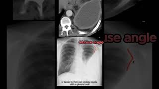 Empyema vs Pleural Effusion vs Lung Abscess radiology radiologystudent medicalstudent [upl. by Matilde49]