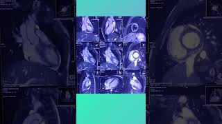 Cardiac mri view anatomy sequences [upl. by Leirud]