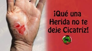 Como evitar que una HERIDA deje CICATRIZ [upl. by Chally]