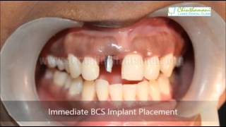 Gum Treatment Chennai  Periodontal Treatment Tamilnadu  Flap Surgery India [upl. by Kwei]