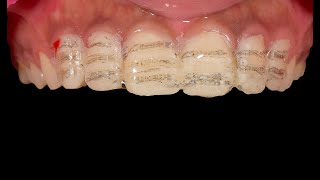 Step by Step Veneer Preparation And Cementation  EMAX Porcelain Veneer  Clinical case [upl. by Hermy]