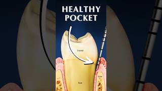 What Is A Gingival Pocket [upl. by Castra648]