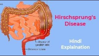 Hirschsprungs Disease with Animation by Ashish Kumar Nursinghindi [upl. by Esoryram]