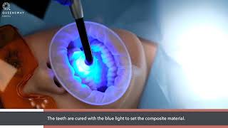 Composite bonding and veneers  how its done [upl. by Noillid]