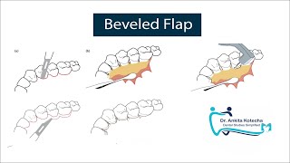 BEVELED FLAP PERIODONTAL FLAP SURGERY ON PALATAL ASPECT MODIFICATION OF APICALLY REPOSITIONED FLAP [upl. by Jerry]