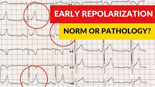 Early repolarization syndrome and pattern Norm or pathology [upl. by Hubert]