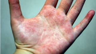 DermTV  How to Treat Eczema DermTVcom Epi 178 [upl. by Eilrac]