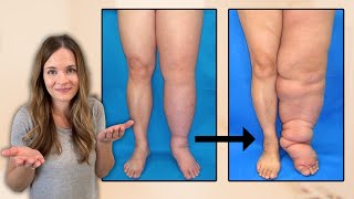 What is Lymphedema [upl. by Ahsieker]