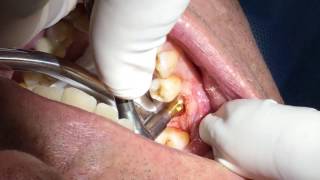 Dental Implant Healing Cap Placement Part 6  Dr John Paul Gallardo  Miami FL [upl. by Annayd605]