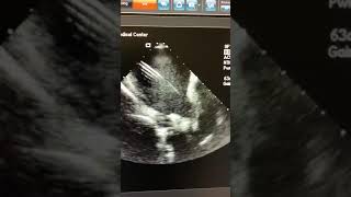 Intracardiac echo of left atrium during afib ablation [upl. by Hahnert]