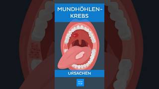 Mundhöhlenkrebs Ursachen  Kenhub shorts [upl. by Adnak]