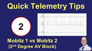 Telemetry Tips  2nd Degree AV Block Mobitz 1 Mobitz 2 and 21 [upl. by Itsrejk]