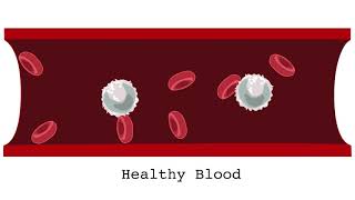 What is acute leukemia [upl. by Hanala503]