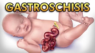 Gastroschisis Pathophysiology Diagnosis Treatment and Comparison against Omphalocele [upl. by Natelson]