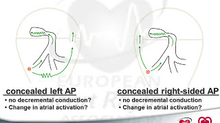 Accessory pathway types and its ablation  Learn from the masters [upl. by Dublin]