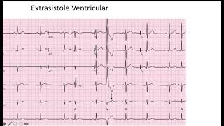 Extrasistole Ventricular EKG [upl. by Levon]