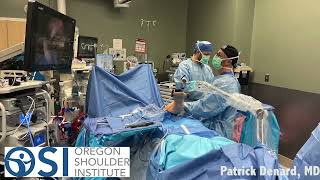 How Will I Be Positioned During Shoulder Arthroscopy [upl. by Derinna]