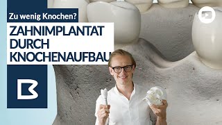 Knochenaufbau für Zahnimplantate  Alle Möglichkeiten genau erklärt [upl. by Madai]