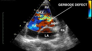 Gerbode Defect Echocardiography [upl. by Hett808]