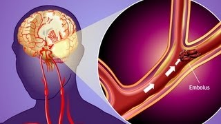 Stroke Prevention amp Transient Ischemic Attack TIA [upl. by Adnuahsar]