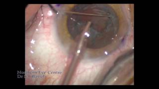 Cataract Extraction and Multifocal IOL 2017 [upl. by Izogn]