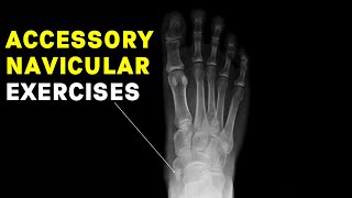 Accessory Navicular Syndrome Exercises by a Foot Specialist [upl. by Castro]