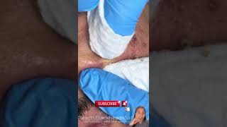 blackheads extractions blackheads and whiteheads blackheads new 2024 today blackhead removal [upl. by Ennayhc]