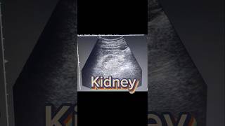 Small Kidney  cortical Thinning  Renal parenchymal Disease on Ultrasound [upl. by Aekin]