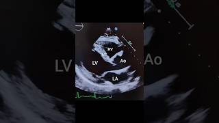 Parasternal Long Axis PLAX view with Color Flow Doppler echocardiography [upl. by Pansir]