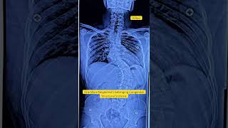 Congenital Structural Scoliosis Treatment By DrRavi scoliosistreatment chiropractic spine chiro [upl. by Dulla]