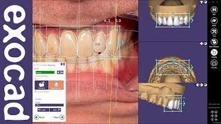 exocad Quick Guide Get the most out of your Smile Creator Module [upl. by Ennyroc252]