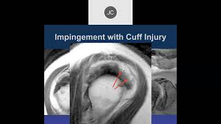 MR of Shoulder Impingement 2023 [upl. by Nodnalb]