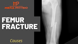 Femur Fracture  Causes  In Hindi  Mera Physio [upl. by Tlihcox]