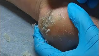 Pedicure  6 mins Podiatry Look at cracked heels Dead skin removal and Cracked heels treatment [upl. by Finlay]