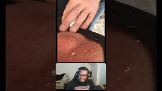 Gushing Back Cyst Pop pimple pimplepop blackhead whitehead shorts [upl. by Gala57]