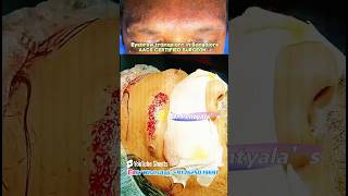 Eyebrow transplant results in Bangalore  drpentyalas eyebrowtransplant results india eyebrows [upl. by Aihc92]