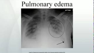 Pulmonary edema [upl. by Loriner454]